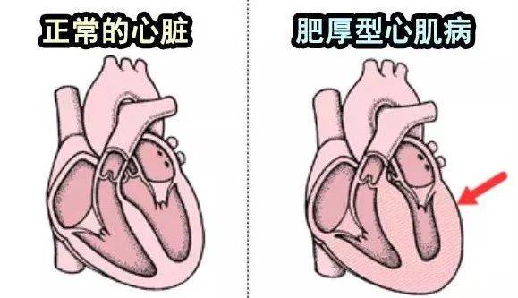 肥厚型心肌病  以未知原因的左心室肥厚为特征,可以继而引发心衰