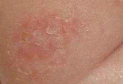 秋季常见干性湿疹 得了它怎么治疗?