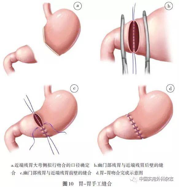 自胃腔内全层间断缝合胃后壁4～5针悬吊固定,以直线切割吻合器完成后