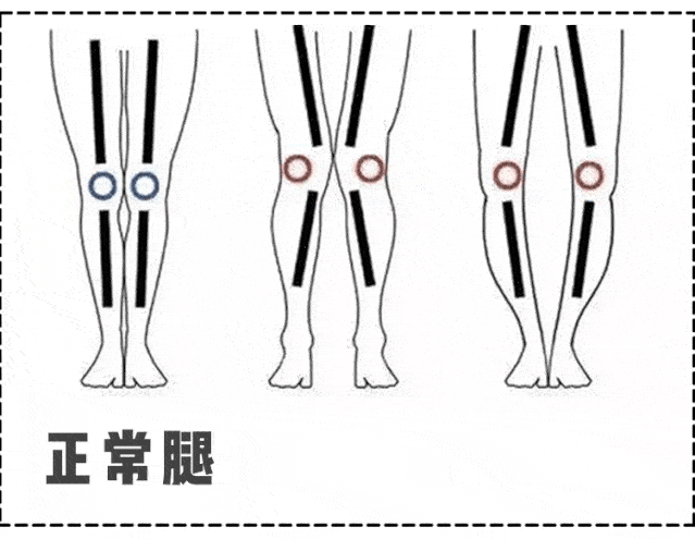 走路内八字的女生,容易形成o型腿.