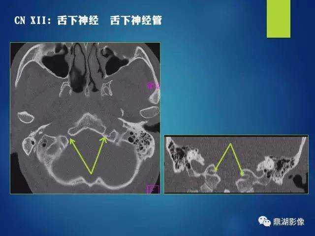 c,高分辨率示踪视觉通路,可以呈现出鼻侧视神经,颞侧视神经,视交叉,视