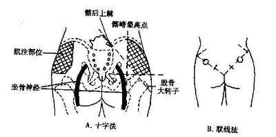 透明臀部肌肉组织骨骼结构神经血管系统模型,上海求育qy-t2