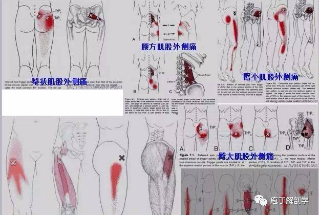 全身激痛点手册(建议收藏)