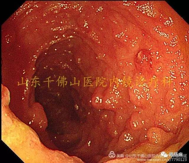 嘴上,手上长黑斑,胃里,肠里长息肉——这种遗传病易癌变