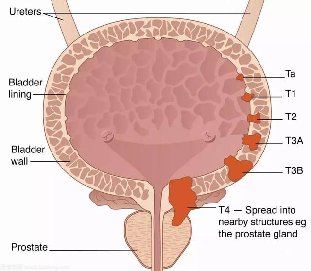 难言之隐背后危险可能悄然靠近!看完这篇文章,了解膀胱癌的所有知识