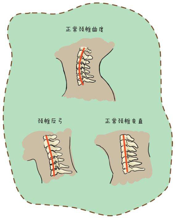 在这种姿势下,下颈椎的关节相对向前弯或者屈曲;同时,上颈椎和头部