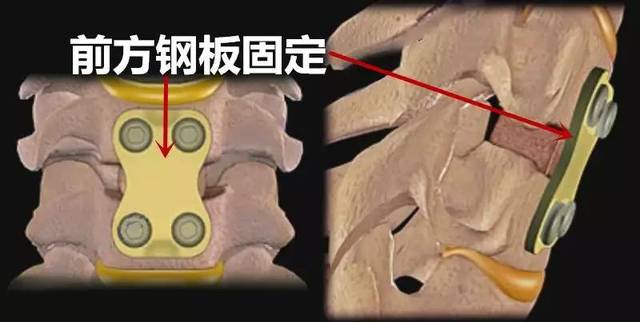 该手术方法主要用于: 1,颈椎病有多节段间盘突出(大于3个节段)造成