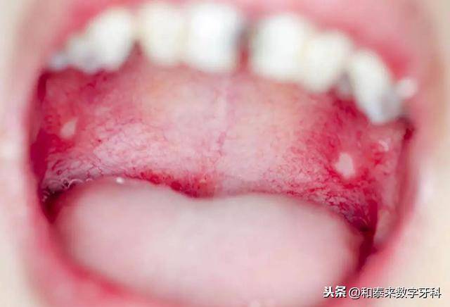 这种"口腔溃疡"可能是口腔癌!口腔癌的几大征兆,你中了吗?