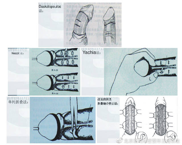 阴茎弯曲的手术方式都有什么?
