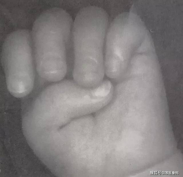 宝宝拇指伸不直,当心患上「板机指」