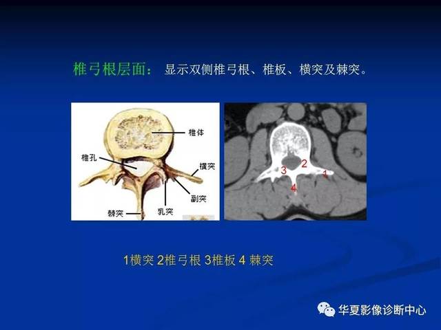 影像重温丨腰椎结核的ct诊断与鉴别诊断