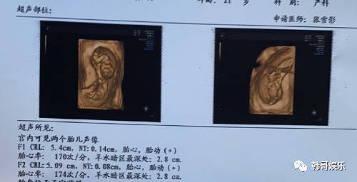 最劲爆大美怀孕双胞胎李四表示被nzbz粉丝感动