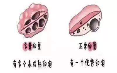 里,卵巢内有太多卵泡"竞争"发育以致于不能出现一个优势卵泡进而成熟