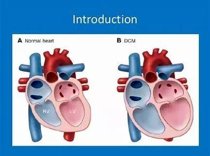 北京地铁一扩心病患者猝死丨有扩张型心肌病,猝死能预防吗?