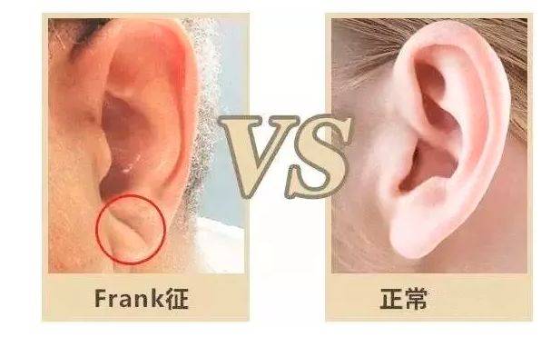 frank征与正常耳垂