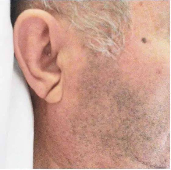 患者出现双侧frank征,为具有诊断意义的耳垂折痕,预示患者可能患有