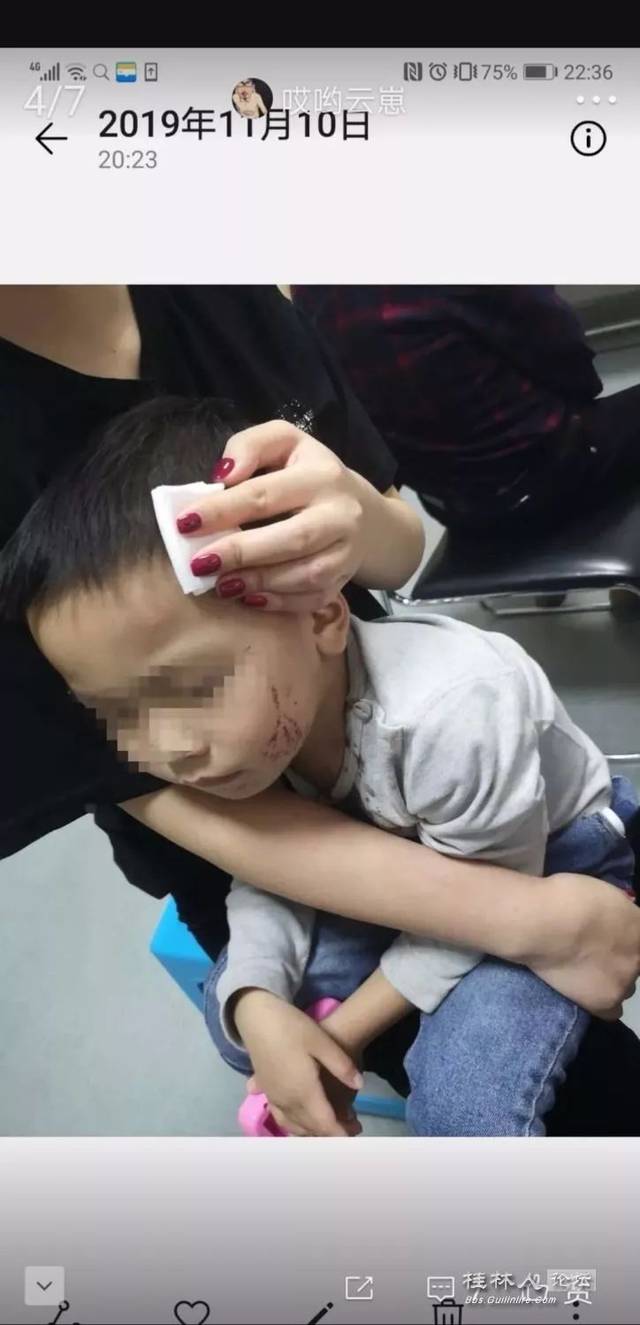 社会丨桂林一小孩被炸伤血流不止,医生一行为气的家长发抖!