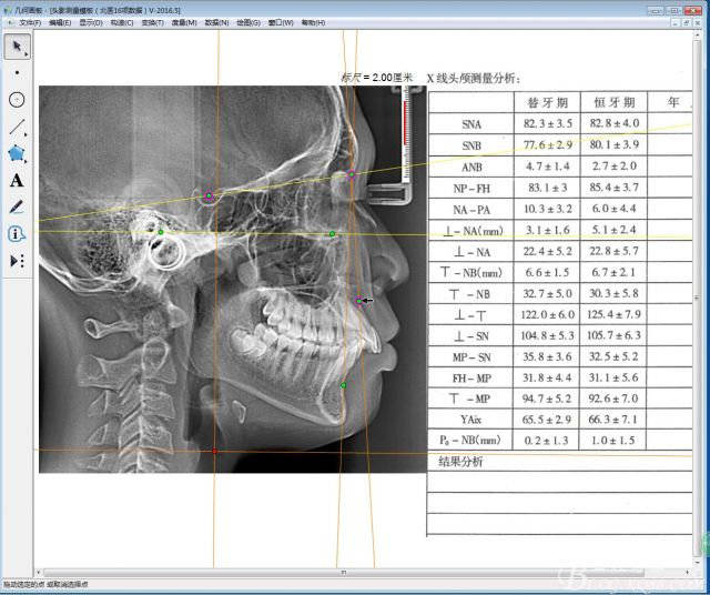 北京牙齿矫正杨磊:什么是头影测量片,什么是头影测量分析?