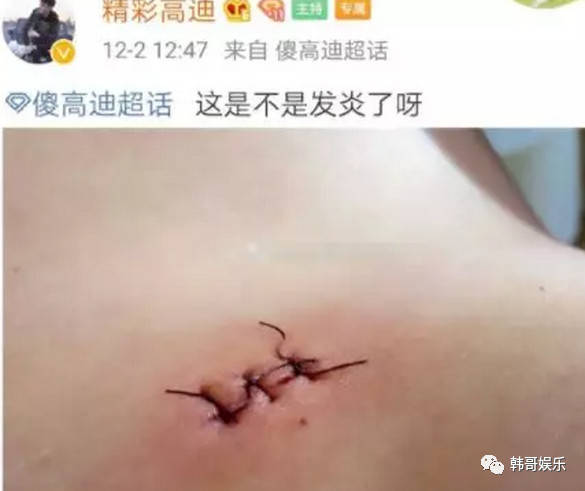 看伤口形状像是刀伤,难道高迪在松原被捅了?
