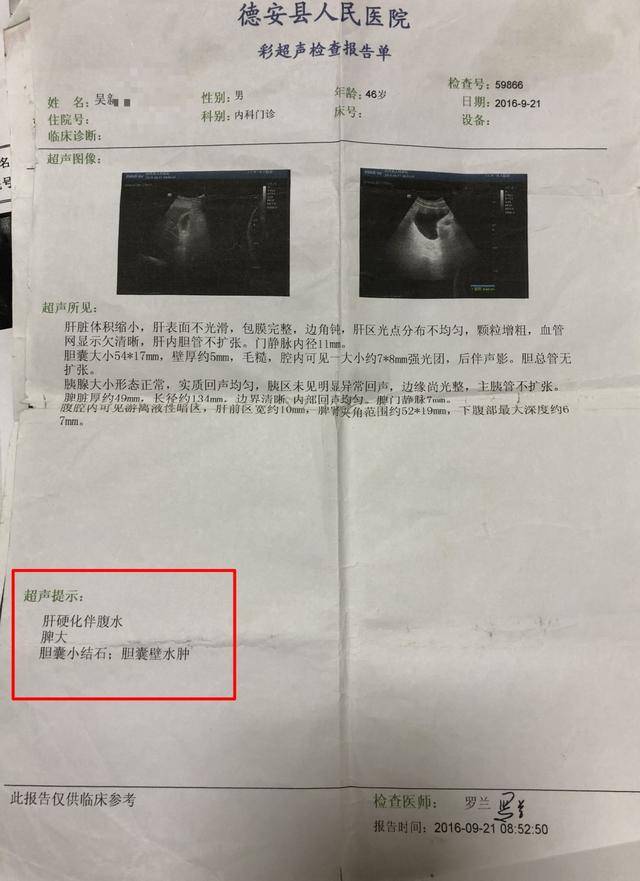 钟伟医生健康谈:乙肝转肝硬化腹水患者,用中药治疗后,坦言现在可扛五