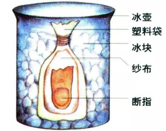 意外发生断指(肢)时怎样进行急救处理和正确保存