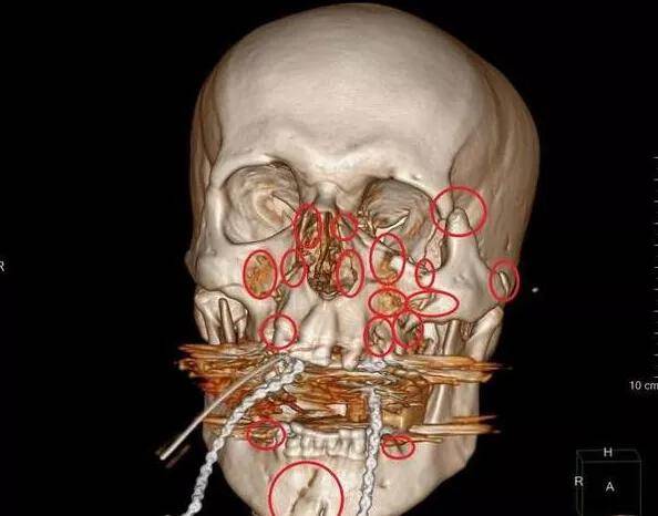了好几根，四肢都有严重的骨折，同时脸骨也有严重的断裂，非常的严重。