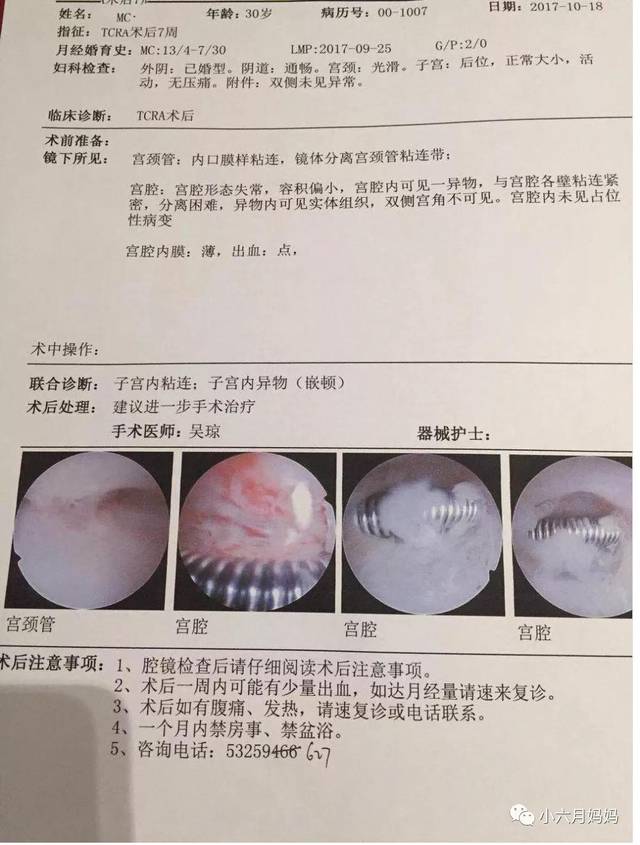 宫腔粘连你是否还在走弯路(下)