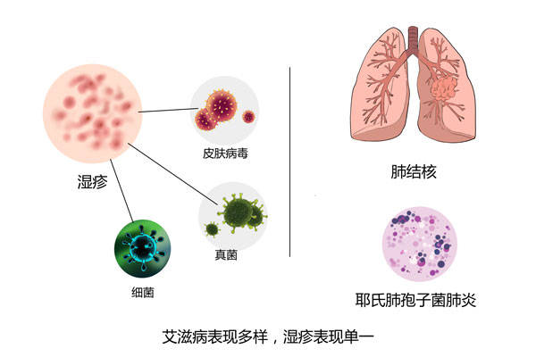 湿疹与艾滋病很相似,教你两招来辨别!