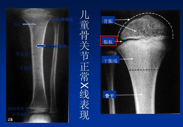 什么是生长板骨折 儿童的长骨分为四个区域,包括 骨骺 骺板