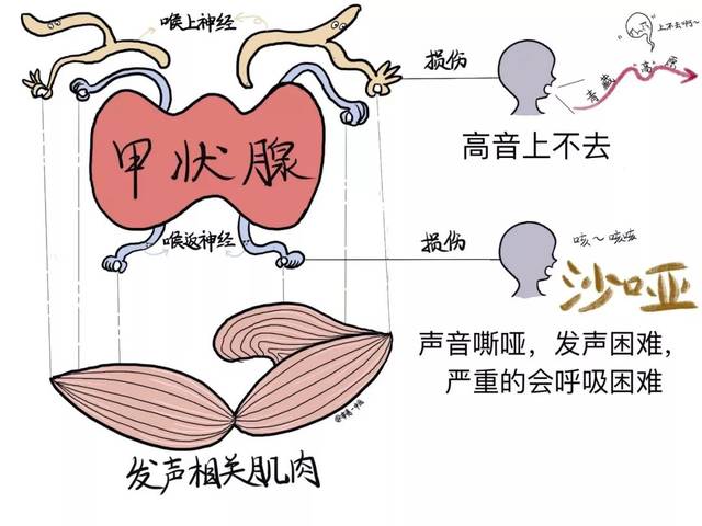 甲状腺和负责支配发声肌肉的神经——喉上神经和喉返神经 紧贴在一起