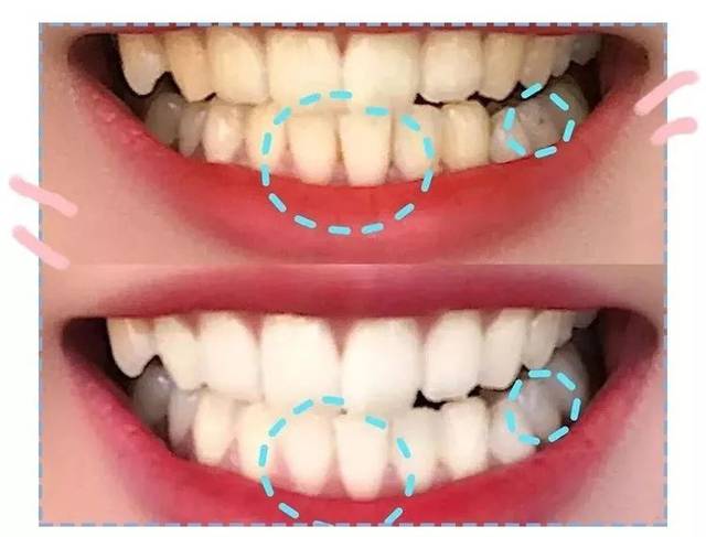 除去了牙菌斑,减少牙结石,牙齿亮晶晶的,让你笑起来更好看!
