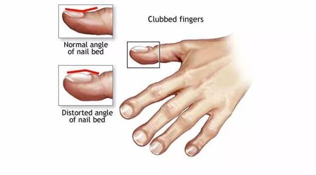 因此,很多人在患肺癌以后手指也会慢慢出现"杵状指"的症状.