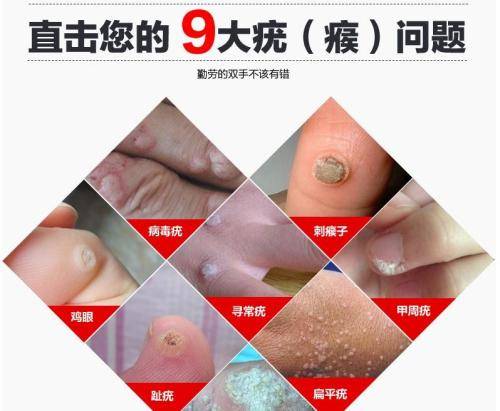 身上长了"疣",像是扁平疣?不要着急,把这2件事做好