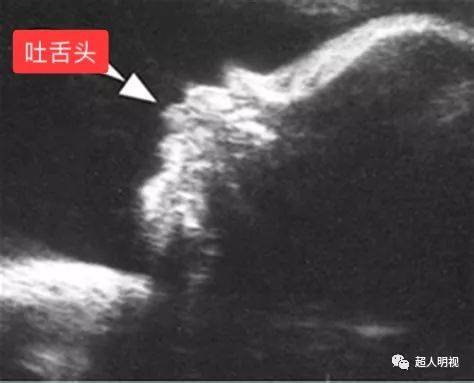孩子总是吐舌头一定是唐氏综合征吗?