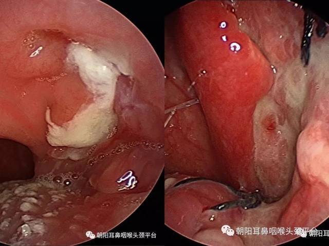 以下图片是扁桃体癌手术前后的对比:              编辑:杜晶艳 审校