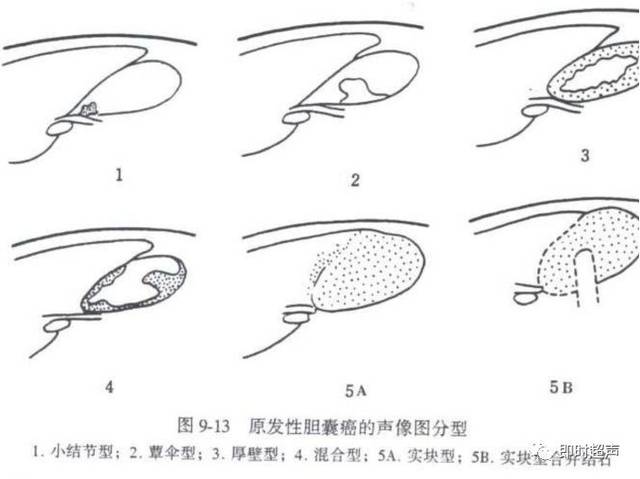 蕈伞型 厚壁型 混合型 实块型 实块型合并结石 i型 小结节型 胆囊癌