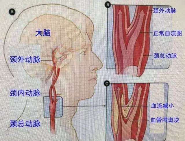 可能是颈动脉堵了!为你介绍3个疏通方法