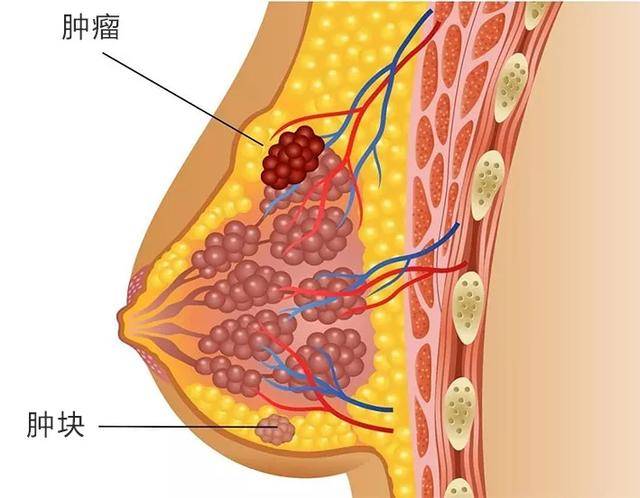 乳腺结核也有可能出现这种边界不清楚的肿块 如果发现