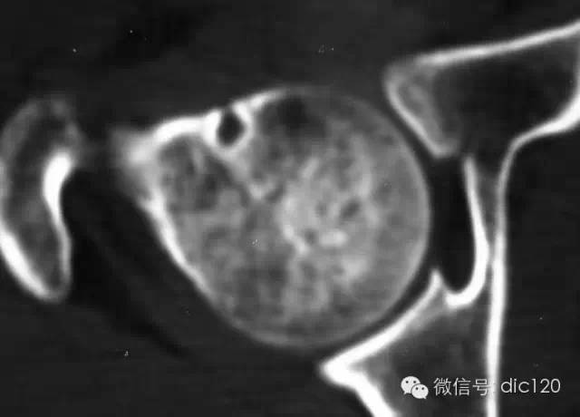 【典型征象】---股骨颈疝窝