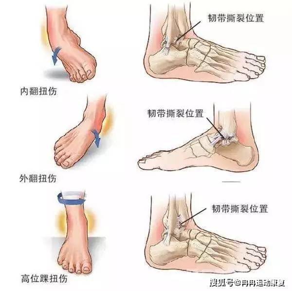 踝关节扭伤后该怎么办?康复师:这几点要多注意