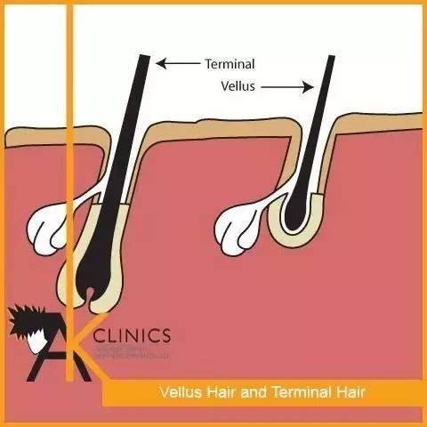 毳毛和终毛除了发干形态上有很大的差别,毛囊也不同.