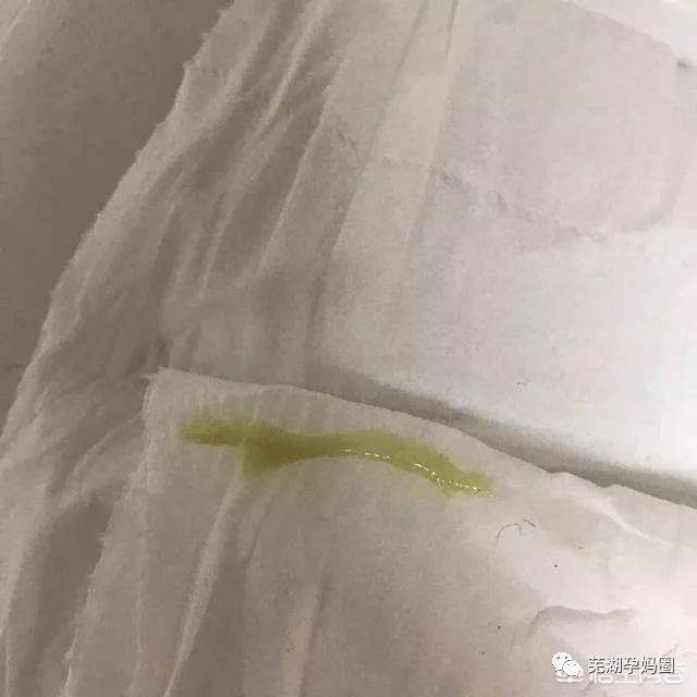 2,咖啡色带血丝:当孕妈有这类分泌物多时候,一是受精卵着床出血导致