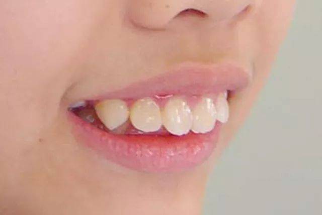 哪些牙齿不齐需要早期矫正  牙齿不齐是指儿童生长发育过程中,由先天