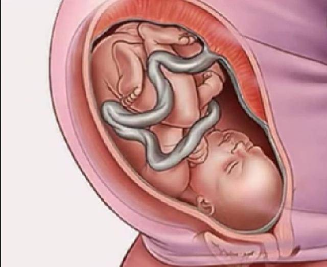 9个月胎儿可不只是头朝下,还有这些姿势,学妈妈的样子