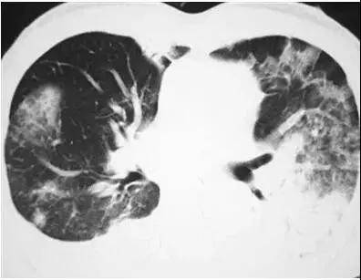 留意!武汉不明原因肺炎临床表现公布 致病
