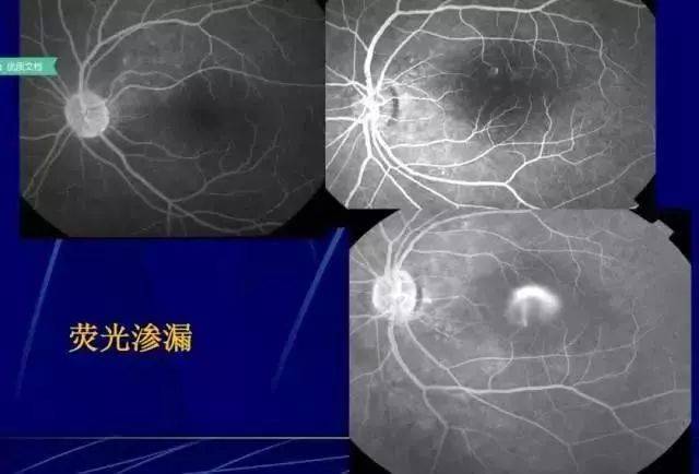 31张图,让你读懂眼底荧光血管造影(值得收藏)