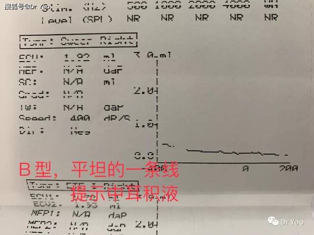 分泌性中耳炎,声导抗a,b,c型图什么意思?