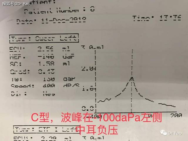 分泌性中耳炎,声导抗a,b,c型图什么意思?