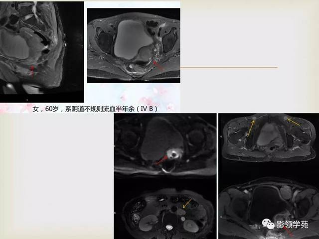 子宫卵巢病变的mri诊断