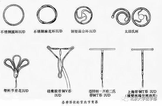 节育环的名声一落千丈.